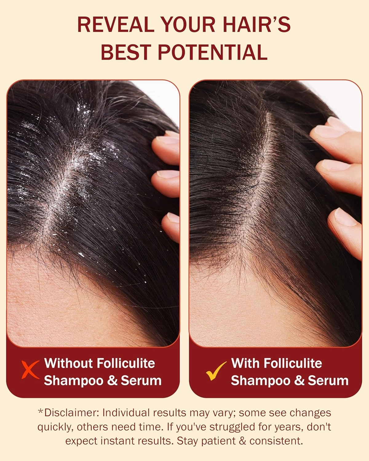 3% BHA Folliculitis Shampoo & Leave-On Hair Serum Set - Made with Salicylic Acid, Aloe Vera & Tea Tree Oil - Moisturizing Shampoo & Hair Oil for Dry Itchy Scalp and Head Acne by e70