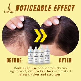 Anti Dandruff Shampoo and Lotion for Hair Growth - All-Natural Thinning Hair Regrowth Formula - Anti Hair Loss Treatment for Women & Men - Ideal for Color Treated Hair - 8 fl. oz.