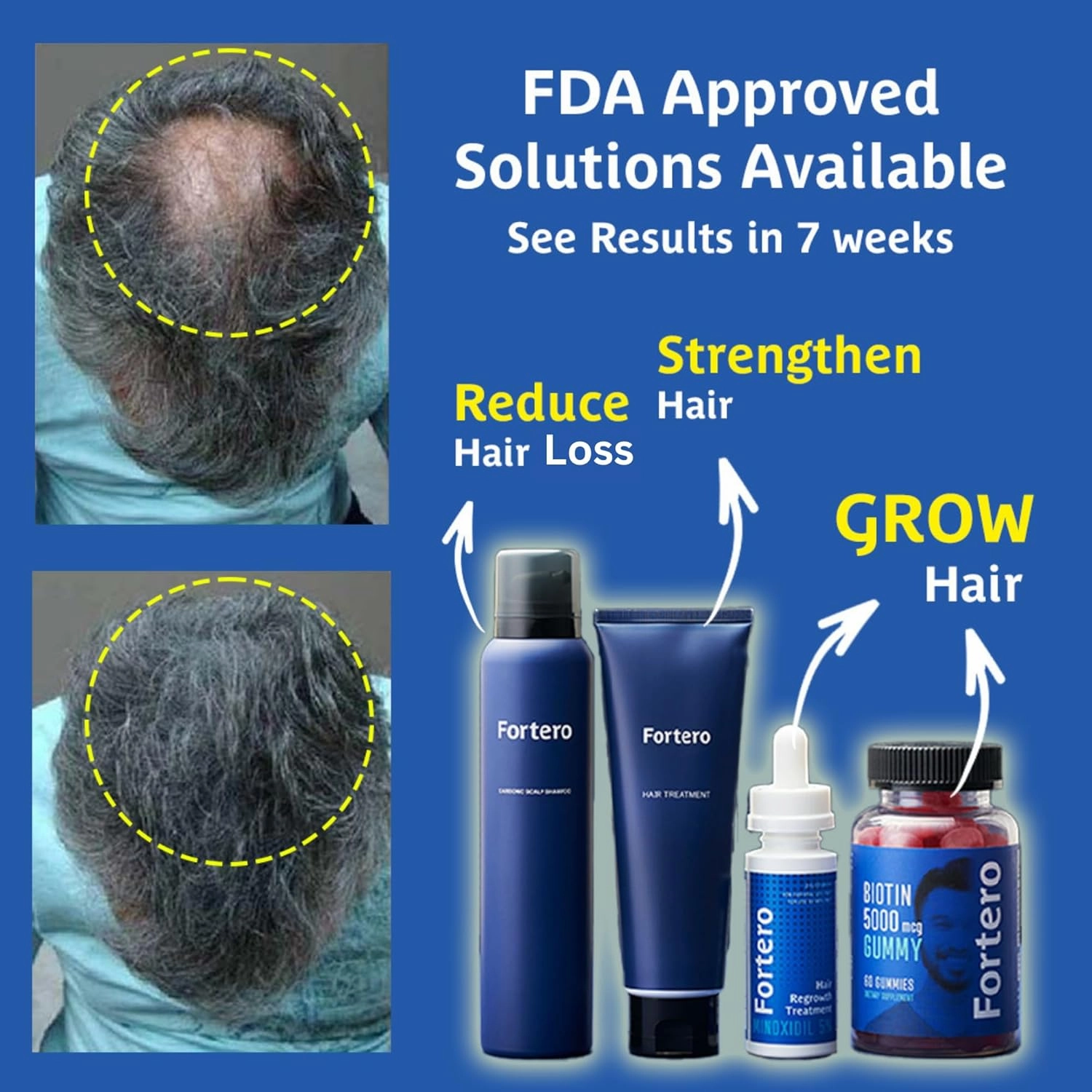 Fortero Hair Regrowth Treatment for Men Shampoo&Conditioner&5% Minoxidil - Anti-Hair Loss Formula for Pattern Baldness, Alopecia - Hair Thinning Treatment (Hair Restoration System Bundle)