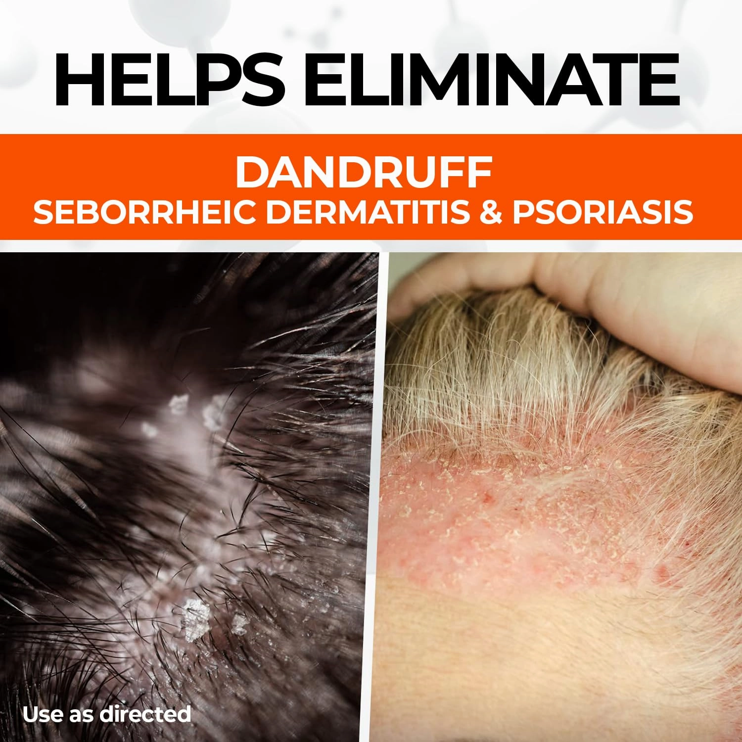 Medicasp Coal Tar Anti-Dandruff Shampoo, Alleviates Symptoms from 1st Wash, Treats Psoriasis, Seborrheic Dermatitis & Itchy Dry Scalp, Fights the Root Cause of Dandruff, Flakes Shampoo, 6 fl oz-2 Pack